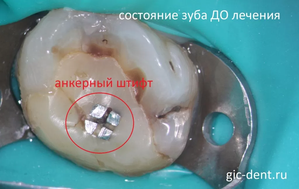 Так выглядит в зубе металлический анкерный штифт, под которым развилось воспаление. Лечащий врач Меликов Азер Фуадович, Немецкий имплантологический центр